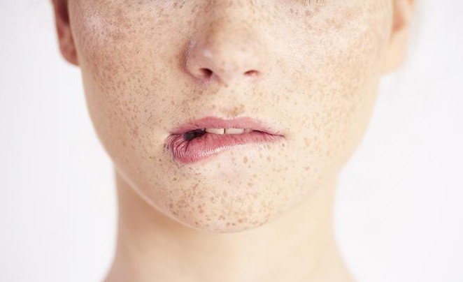 Что нужно знать о лазерной эпиляции при гиперпигментации и склонности к рубцеванию - «Новости Медицины»